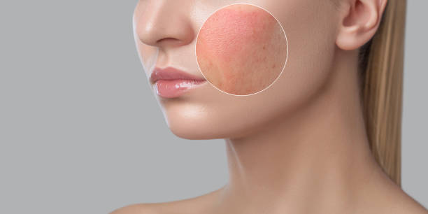 remove skin tan clinic in matunga